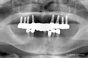 上顎8本のインプラント03
