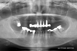 上顎の全体的インプラント症例1
