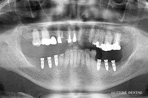 下顎臼歯部インプラント部分症例1
