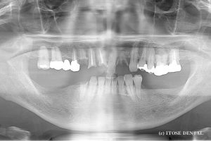 下顎インプラント