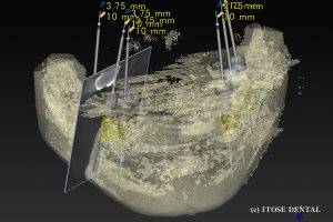 下顎インプラント2