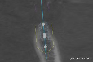 下顎インプラント3