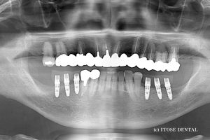 下顎6本の部分インプラン