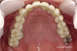 下顎6本の部分インプラント2