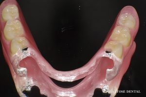 大分の入れ歯治療イメージ