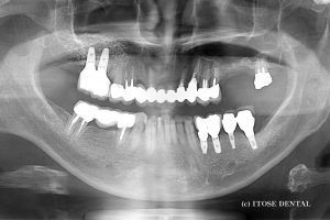 大分市のインプラント治療前
