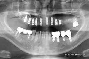 大分市のインプラント治療後
