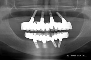 10年経過したインプラント症例