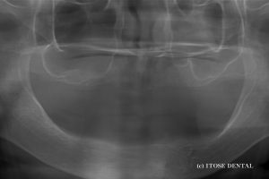 10年経過したインプラント症例
