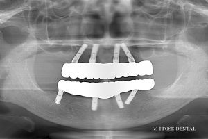 上下のインプラント症例