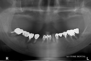 上下のインプラント症例