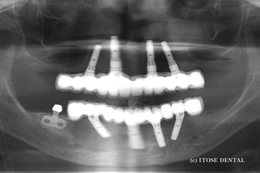 大分でインプラント（オールオン４）を受けられた症例