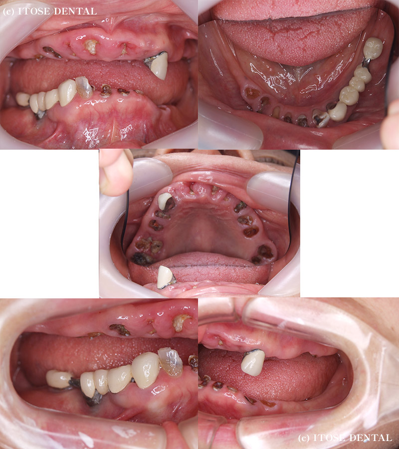 インプラント手術前
