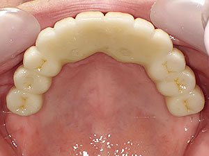 大分のインプラントオールオン4