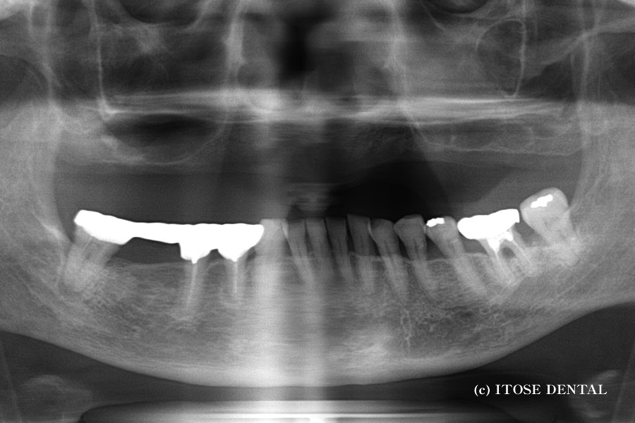インプラント治療前
