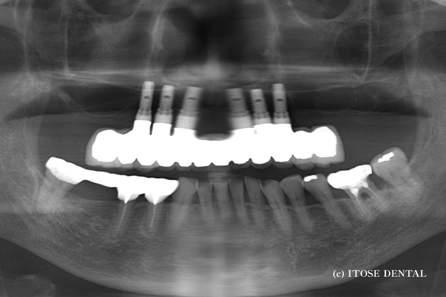 全顎的インプラント治療後