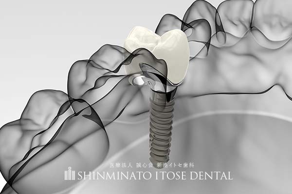 喫煙がインプラントに及ぼす影響