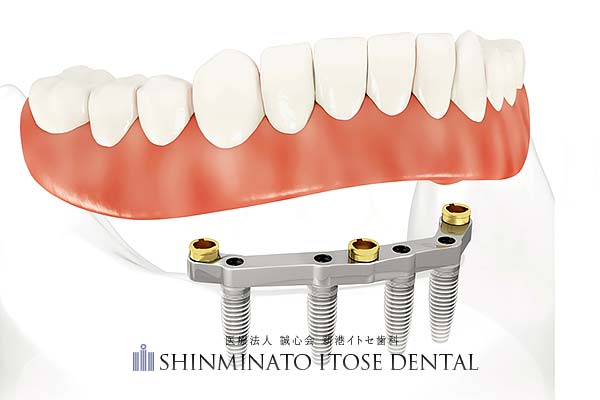 インプラント義歯