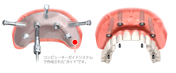 コンピューターガイドシステムで作成