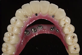 人工歯（上部構造）の装着