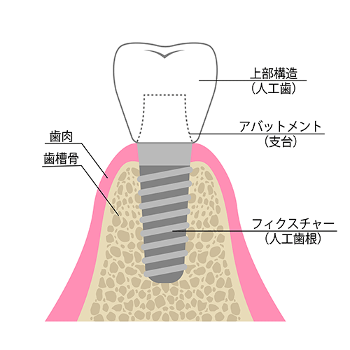 インプラントの構造図