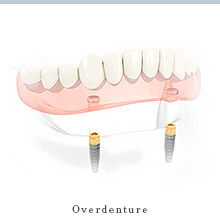 overdenture