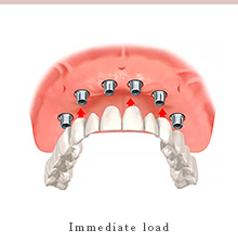 immediate load