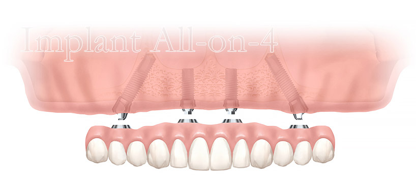 インプラントオールオン4