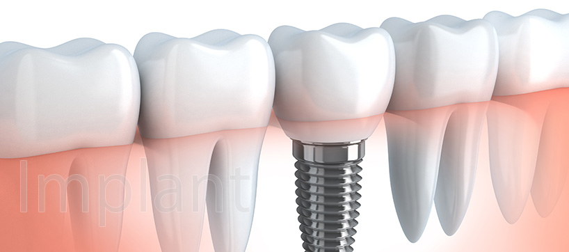 インプラント（人工歯根）