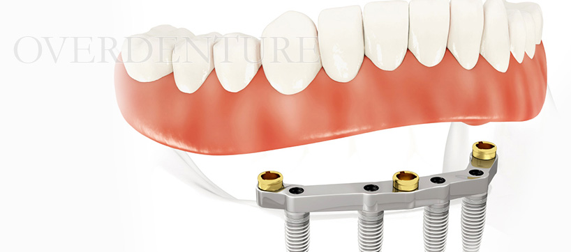 インプラントオーバーデンチャー