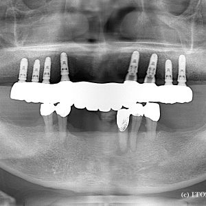 インプラント症例