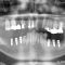 下顎臼歯部インプラント部分症例1