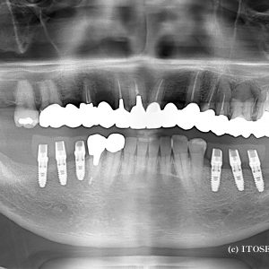 下顎6本の部分インプラン