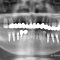 下顎6本の部分インプラン