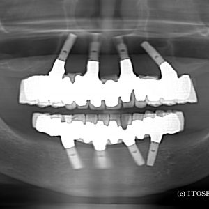 10年経過したインプラント症例