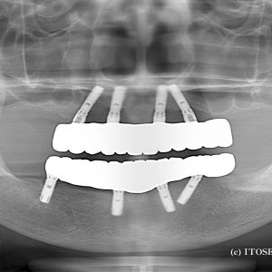 上下のインプラント症例