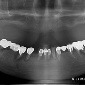 上下のインプラント症例