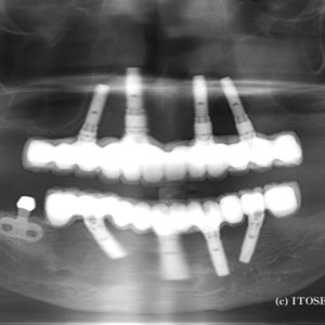 大分でインプラント（オールオン４）を受けられた症例