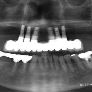 全顎的インプラント治療後