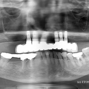 上顎フルインプラントブリッジ