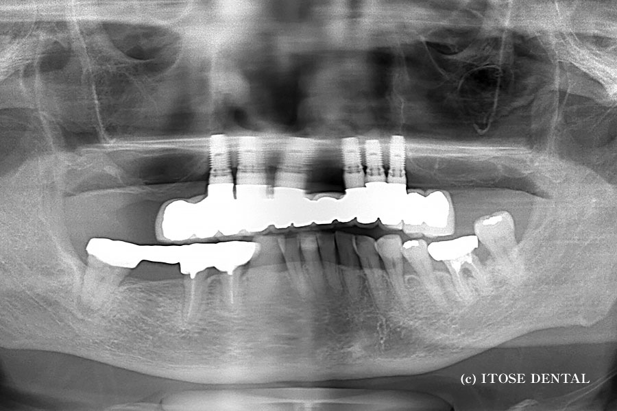 上顎フルインプラントブリッジ
