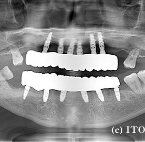 インプラント治療後