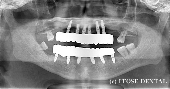 インプラント治療後