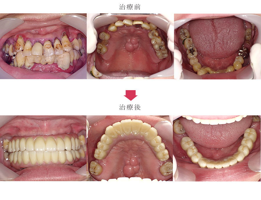 上下全顎的インプラント症例